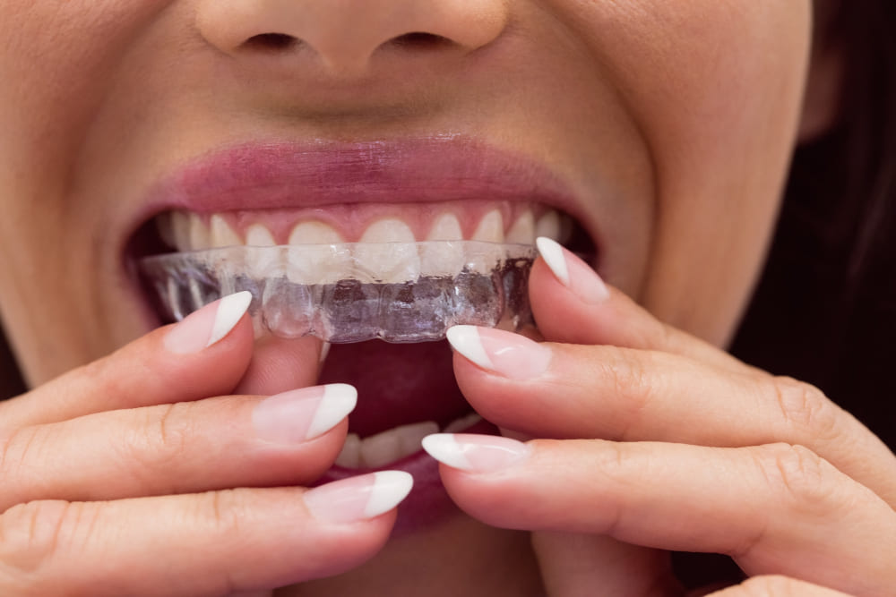 bite-dentale Milano